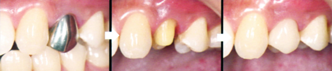 CAD/CAMハイブリッドセラミックスの治療例：保険適用で銀歯から白い歯へ！